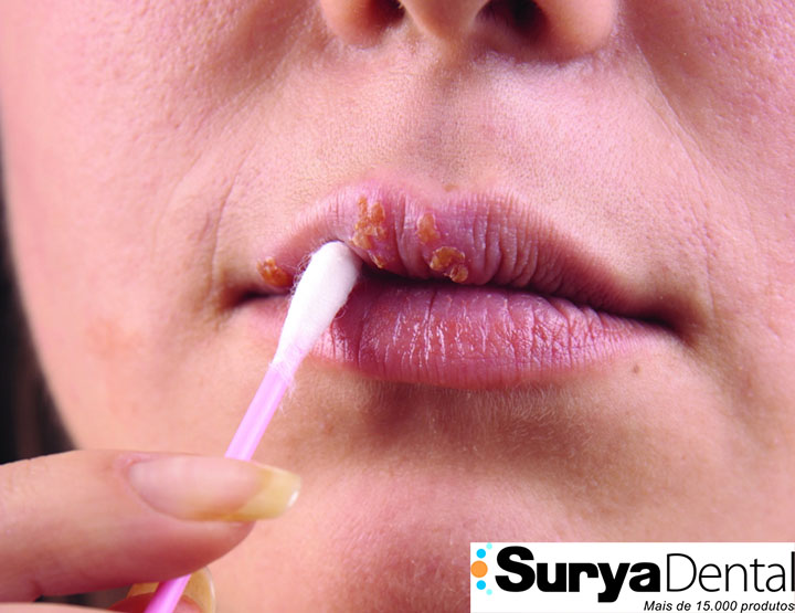 Higiene oral diminui risco de HPV