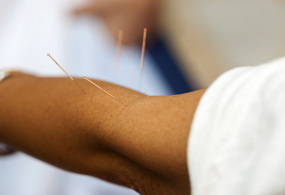 acupuntura odontologia uso da acupuntura