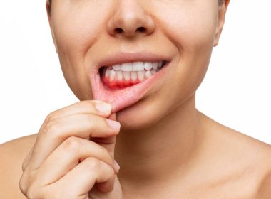 Pessoa mostrando gengivas e dentes saudáveis