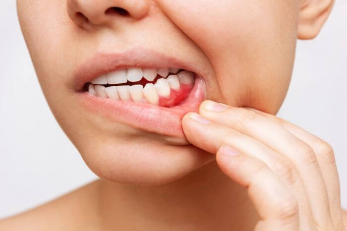 periodontite doença na boca