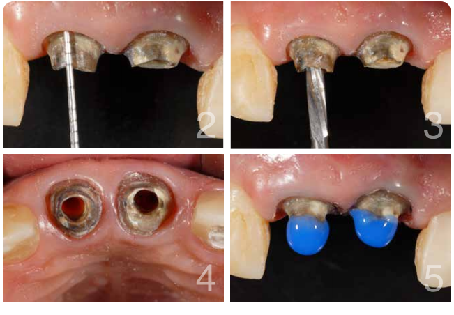 Aspecto inicial dos dentes, quantidade do remanescente dental e preparo dos condutos com broca White Post DC2 (FGM)