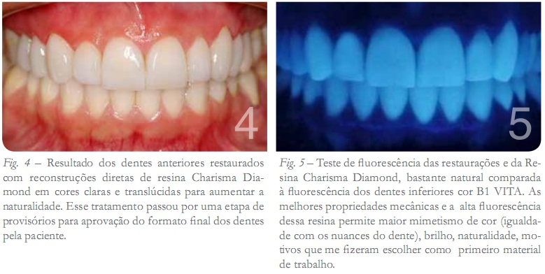 Resultados dos dentes anteriores restaurados com reconstruções diretas de reina Charisma Diamond