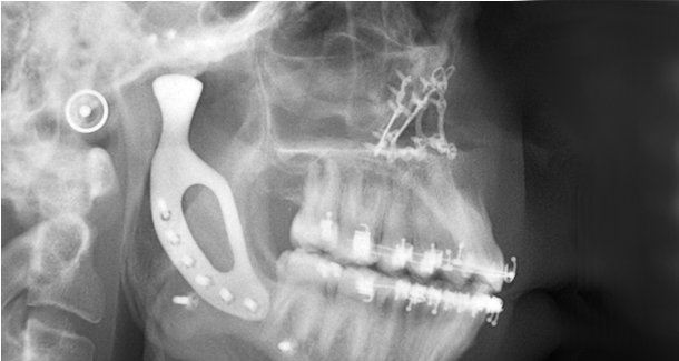 Cirurgiões de Melbourne implantaram a primeira prótese impressa em 3D