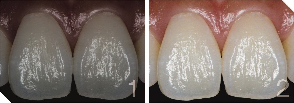 fotos de dentes com flash e diferentes configurações