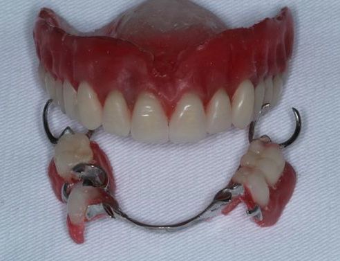 Montagem dos dentes