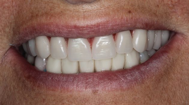 Prova estética dos dentes
