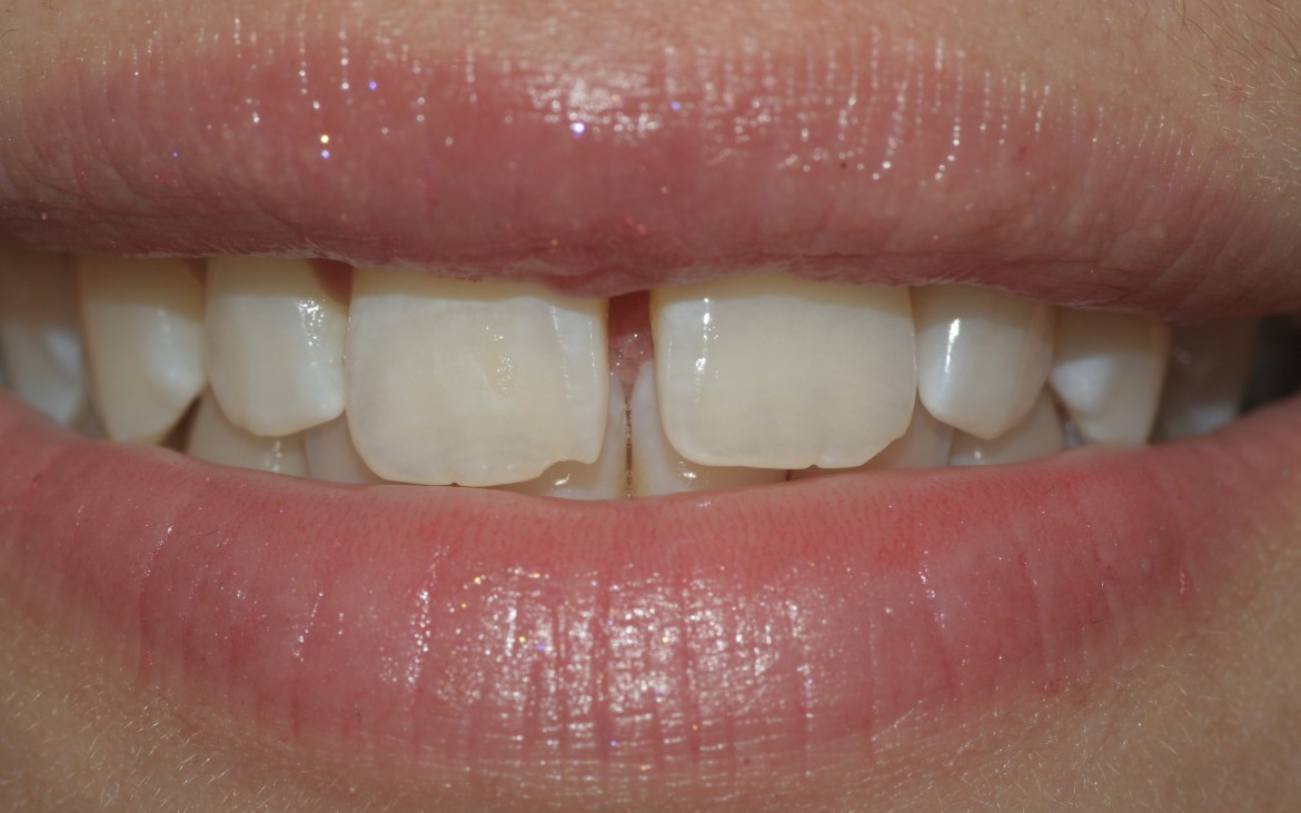 Paciente do sexo feminino, jovem e com a presença de grande diastema entre os elementos 11 e 21. Vista frontal do sorriso. Paciente do sexo feminino, jovem e com a presença de grande diastema entre os elementos 11 e 21. Vista frontal do sorriso.