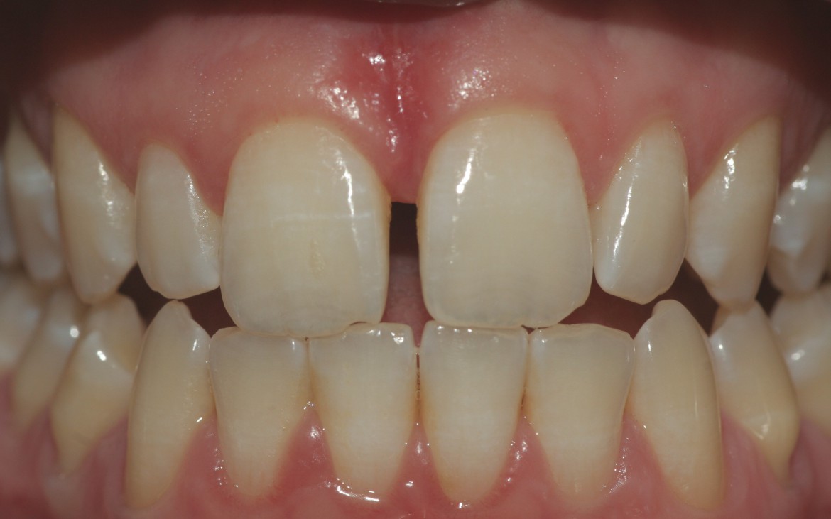 Vista frontal da paciente em oclusão e com lábios e bochechas afastadas. Vista frontal da paciente em oclusão e com lábios e bochechas afastadas.