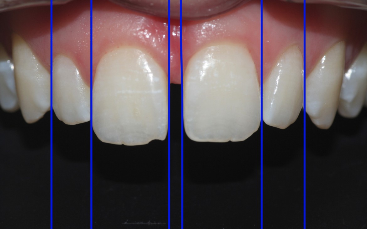 Análise virtual da proporção dental dos incisivos que obedece a norma de estética (proporção áurea). Nesse caso, é inviável a oclusão pura e simples do diastema, sendo necessária a redistribuição do espaço e, a consequente redução do diastema entre os dentes 11 e 21. Análise virtual da proporção dental dos incisivos que obedece a norma de estética (proporção áurea). Nesse caso, é inviável a oclusão pura e simples do diastema, sendo necessária a redistribuição do espaço e, a consequente redução do diastema entre os dentes 11 e 21.