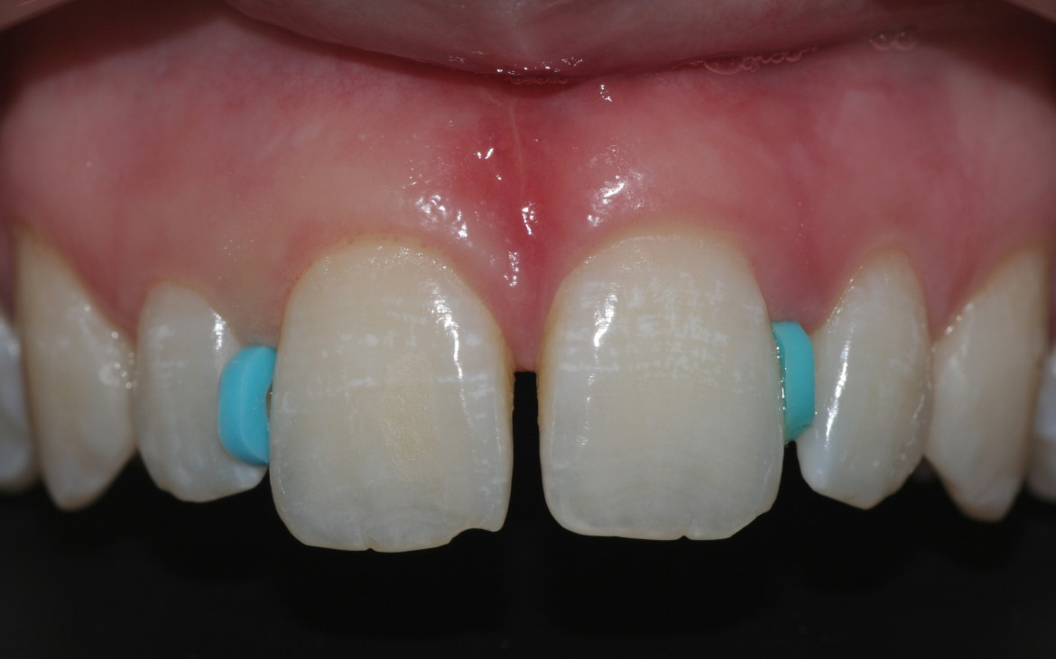 Anéis ortodônticos de borracha com 1,0 mm de espessura posicionado entre os dentes 12-11 e entre 21-22. Após 24 a 48 horas os dentes 11 e 21 migrarão em sentido mesial. Anéis ortodônticos de borracha com 1,0 mm de espessura posicionado entre os dentes 12-11 e entre 21-22. Após 24 a 48 horas os dentes 11 e 21 migrarão em sentido mesial.