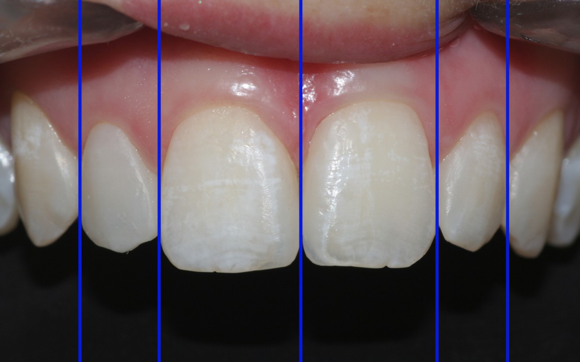Análise virtual da proporção dental dos incisivos que continua em concordância com a norma de estética (proporção áurea), mesmo após a execução das restaurações. Observe que apesar do aumento na largura dos incisivos superiores, prevalece a harmonizado sorriso. Análise virtual da proporção dental dos incisivos que continua em concordância com a norma de estética (proporção áurea), mesmo após a execução das restaurações. Observe que apesar do aumento na largura dos incisivos superiores, prevalece a harmonizado sorriso.