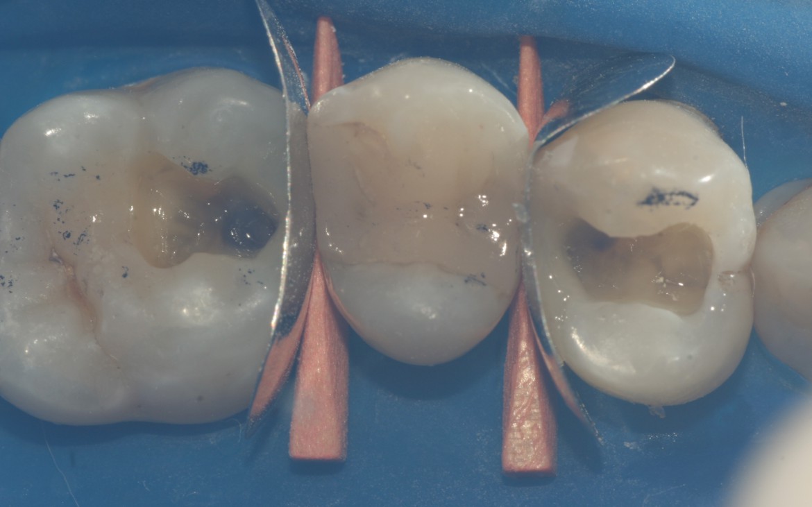 Inserção da resina Charisma Diamond cor A3 em porção única para reconstrução da face mesial do dente 26 e distal do dente 24. Fotoativação por 40 segundos.