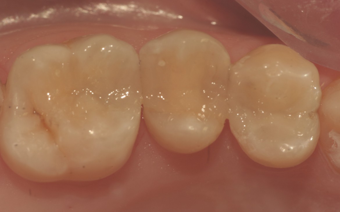 Caso concluído após o polimento e aplicação do selante de superfície para resina composta. Caso concluído após o polimento e aplicação do selante de superfície para resina composta.