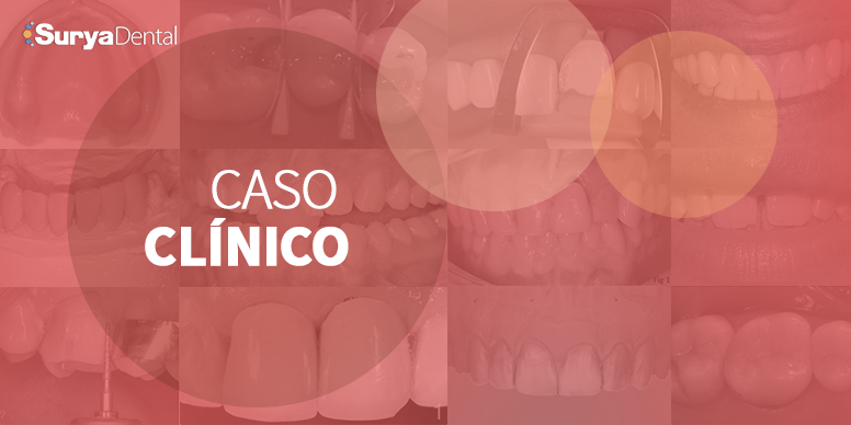 Caso Clínico - Como otimizar as restaurações em dentes posteriores