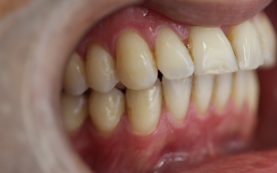 Oclusão tipo classe II de angle com overjet acentuado de 6mm. Oclusão tipo classe II de angle com overjet acentuado de 6mm.