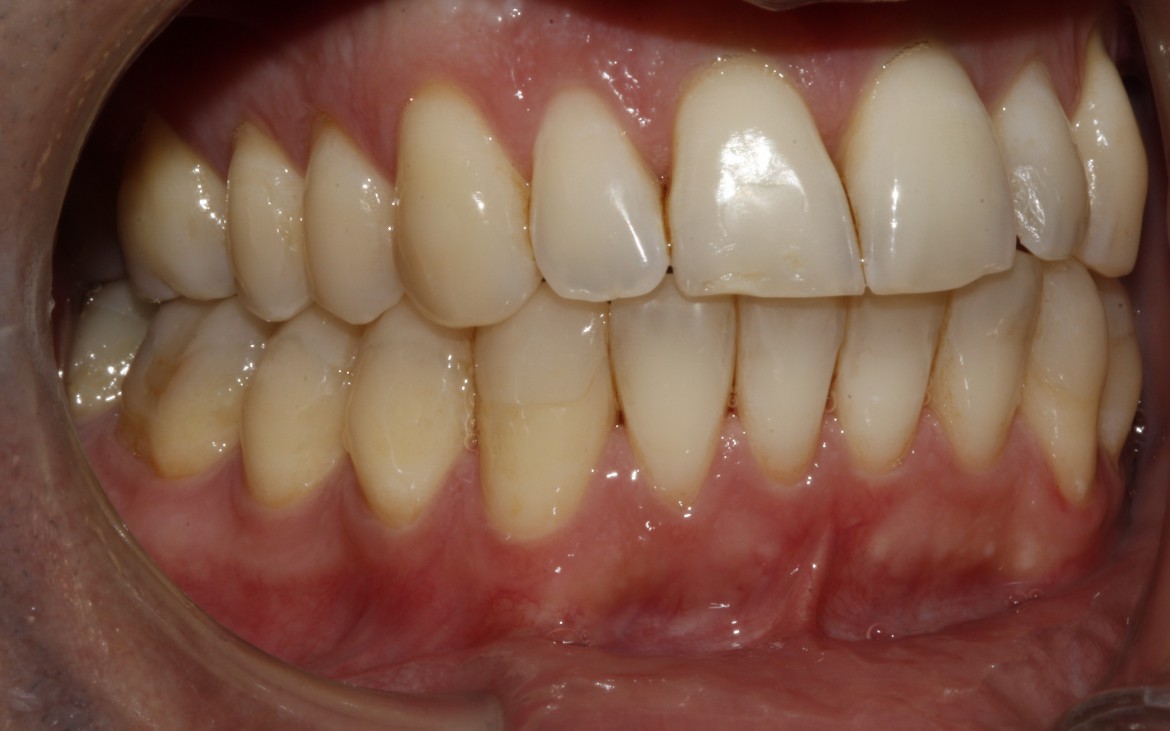 Vista lateral direita - caninos e molares corrigidos na relação oclusal classe I de angle. Vista lateral direita - caninos e molares corrigidos na relação oclusal classe I de angle.