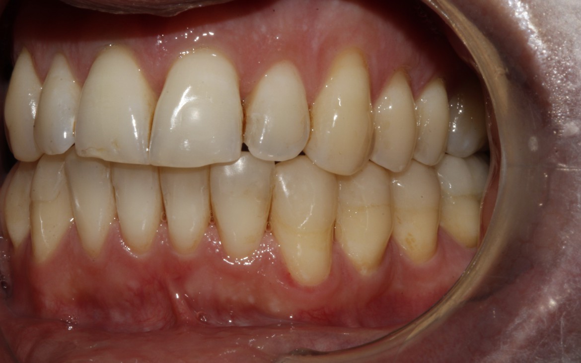 Vista lateral esquerda: Caninos e molares na relação oclusal classe I de Angle. Guia de lateralidade e guia anterior reestabelecidos. Vista lateral esquerda: Caninos e molares na relação oclusal classe I de Angle. Guia de lateralidade e guia anterior reestabelecidos.