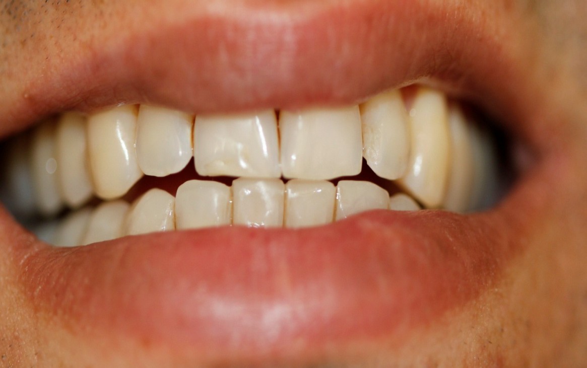 Guia anterior suave – ainda não realizadas as lâminas nas palatinas dos dentes superiores anteriores. Guia anterior suave – ainda não realizadas as lâminas nas palatinas dos dentes superiores anteriores.