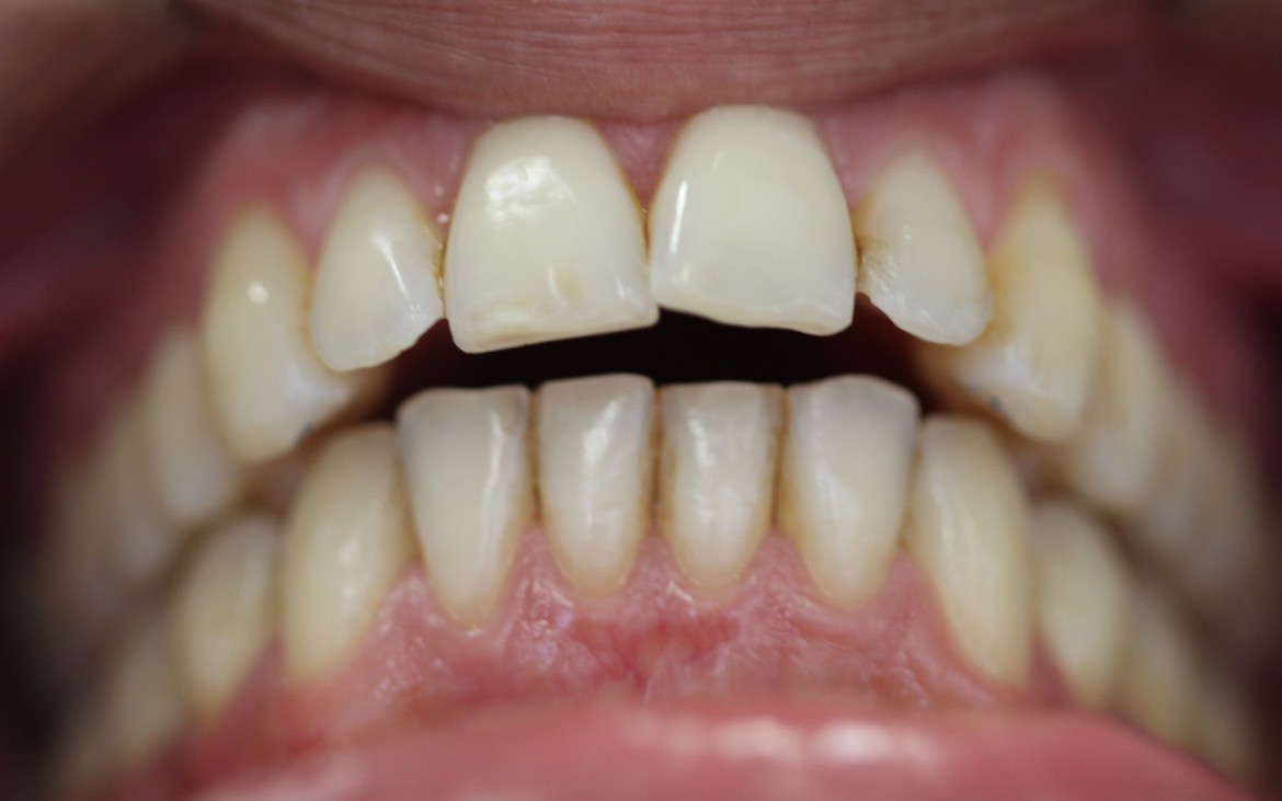 Maxila e mandibula atresiadas. (Overjet anterior de 5mm) Maxila e mandibula atresiadas. (Overjet anterior de 5mm)