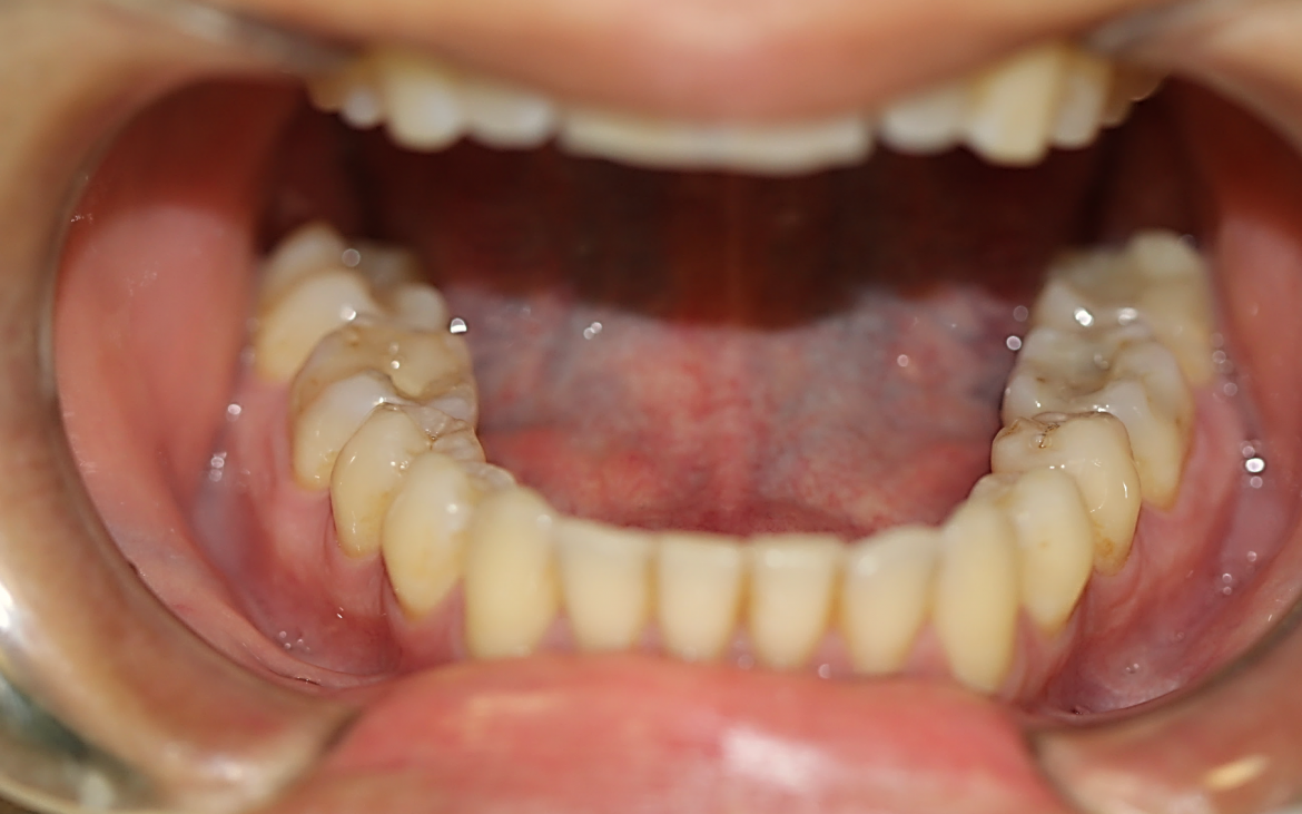 Vista oclusal dos dentes inferiores (Cor A3) Vista oclusal dos dentes inferiores (Cor A3)