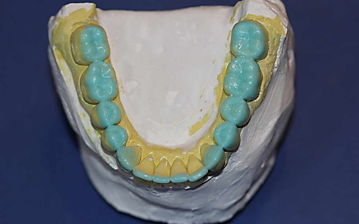 Ceroplastia realizada nos terço incisais dos anteriores e oclusal dos posteriores inferiores. Ceroplastia realizada nos terço incisais dos anteriores e oclusal dos posteriores inferiores.