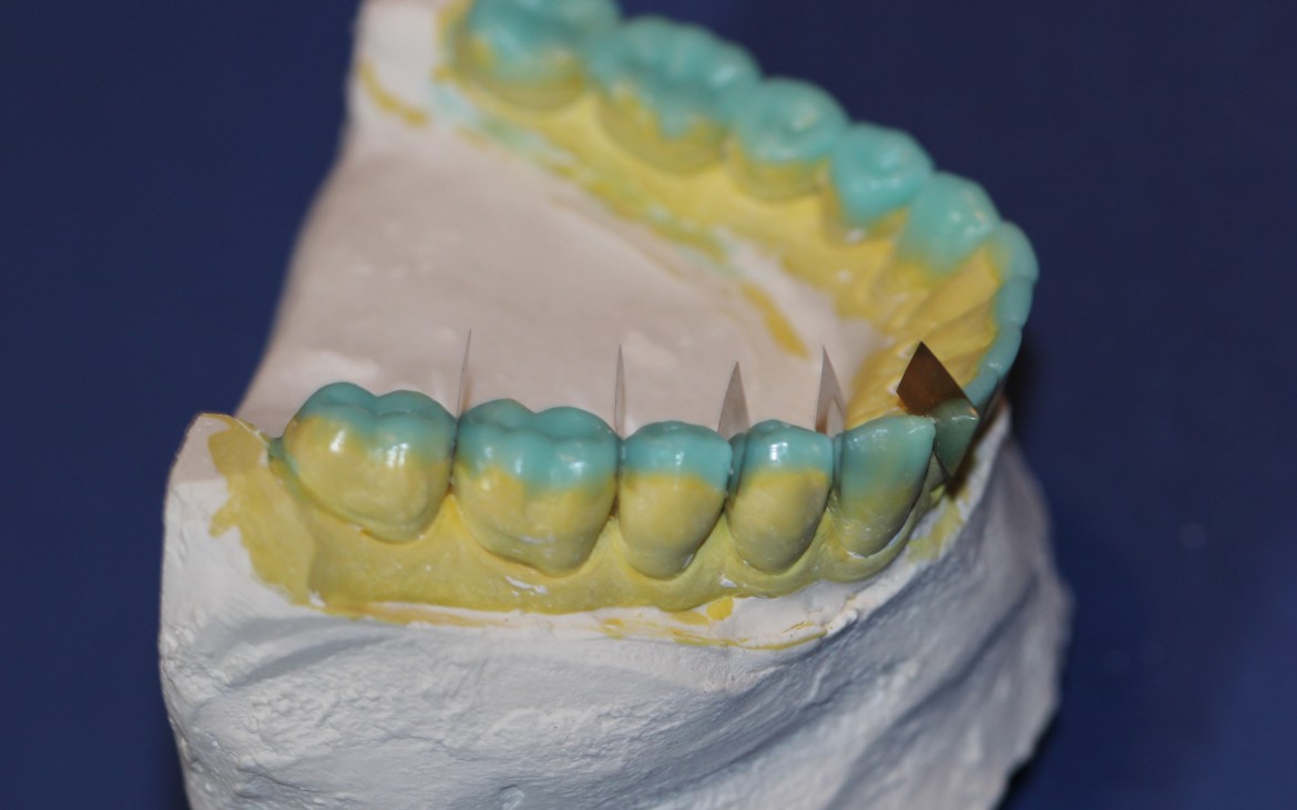 Dentes posteriores – vertentes internas rasas, formato oclusal lobular cheio valorizando sulcos principais e sulcos de escape. Dentes posteriores – vertentes internas rasas, formato oclusal lobular cheio valorizando sulcos principais e sulcos de escape.