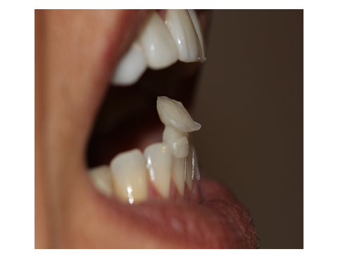 JIG anterior com reposicionamento mandibular. Faceta palatina no dente 11. Bordo incisal no dente 41.