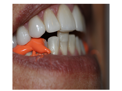 JIG anterior e registro oclusais O’Bite nos dentes posteriores bilateral.