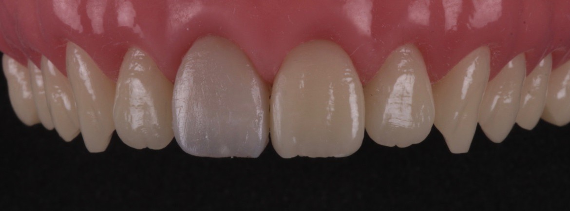 Resina de esmalte aplicada por sobre a dentina artificial, construindo assim a superfície vestibular (E1).