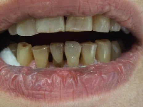 Faceta direta maquiada no dente 31. Prova da correção da cor com pigmentos - cinza e marrom