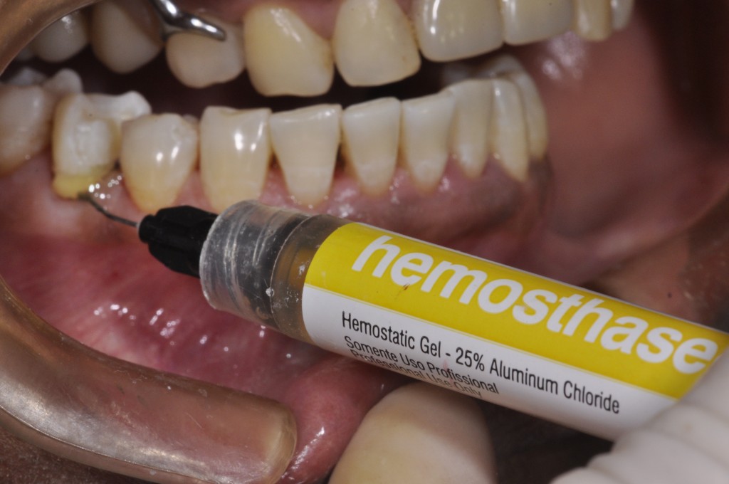 Hemosthase (FGM), gel hemostático utilizado para conter o sangramento gengival.