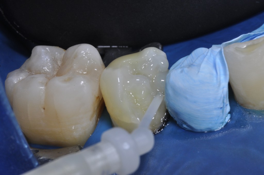 Aplicação do cimento Allcem Core (FGM), sobre o dente preparado