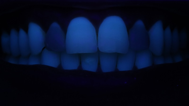 Sorriso inicial do paciente sobre luz negra evidenciando a falta de fluorescência das facetas nos elementos 12 e 22.