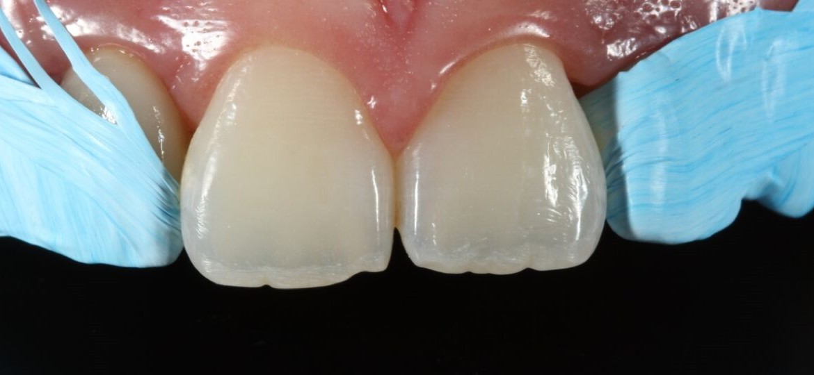 Proteção dos dentes vizinhos com Teflon - Isotape (TDV)