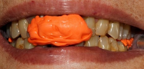 Correção de desvio mandibular e reposicionamento anterior da mandíbula (2mm): Registro de Mordida