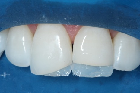 Aspecto da porção palatina reconstruída no dente