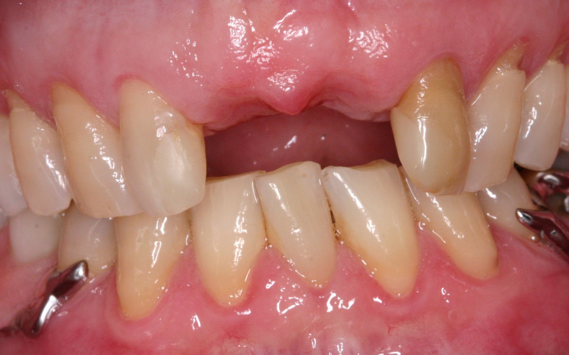 No exame clínico e radiográfico inicial, constatou-se ausência dos dentes 11 e 21.
