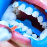 Boca aberta mostrando os dentes enquanto dentista faz clareamento