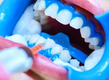 Boca aberta mostrando os dentes enquanto dentista faz clareamento