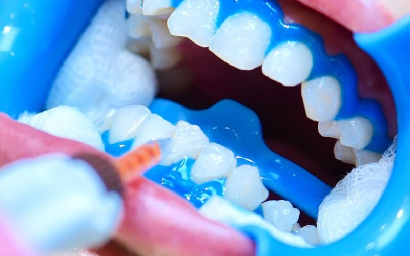 Boca aberta mostrando os dentes enquanto dentista faz clareamento