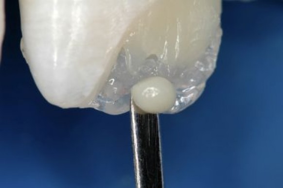 Estratificação dentinária proporcionada pelos diferentes cromas de dentina