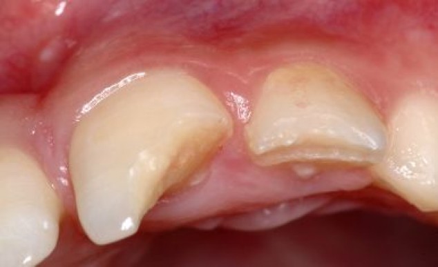 Vista inicial do caso, detalhando a fratura do dente 21