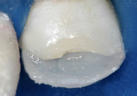 A resina Llis DA3,5 (FGM) foi utilizada para confecção do corpo dentinário