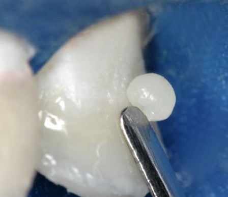 Retomada a hidratação dental, resultado após acabamento com discos de lixa Diamond Pro (FGM) e polimento com discos de feltro Diamond Flex (FGM) e pasta diamantada Diamond Excel (FGM)