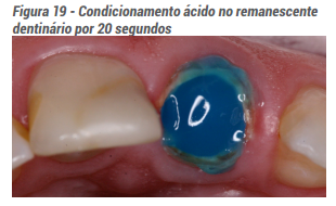 Condicionamento ácido no remanescente dentinário por 20 segundos