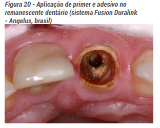 Aplicação de primer e adesivo no remanescente dentário (sistema Fusion Duralink - Angelus, brasil)