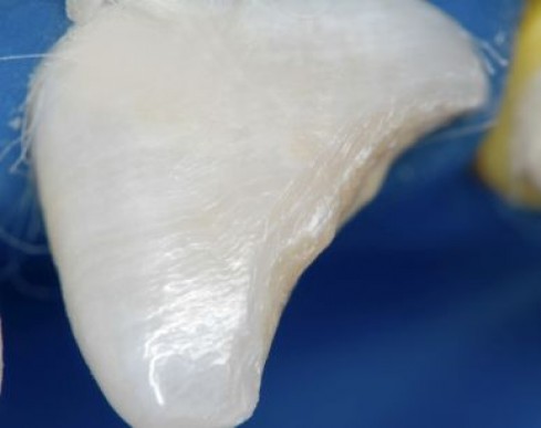 O esmalte palatino foi restabelecido com Resina Llis (FGM) Incisal (translúcida)