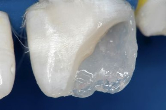 Início da confecção do corpo dentinário com Resina Llis DA3,5 (FGM)