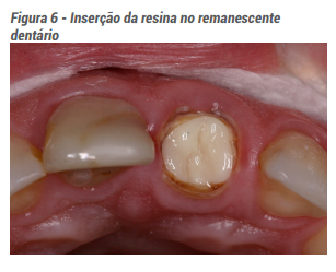 Figura 6 - Inserção da resina no remanescente dentário