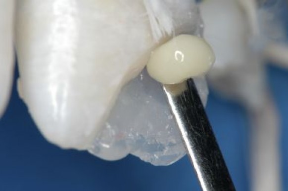 Início da confecção do corpo dentinário com Resina Llis DA3,5 (FGM).